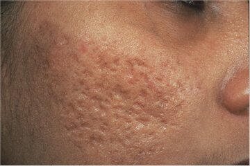 acne_scars1.jpg